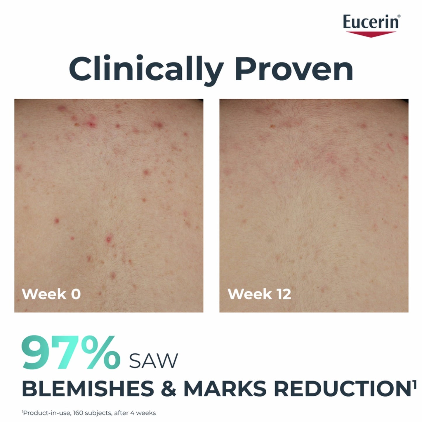 Eucerin Dermopure Clinical تونر منقي لحب الشباب والعيوب والرؤوس السوداء، 200 مل