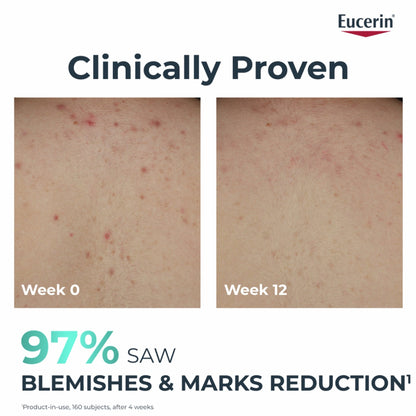 Eucerin Dermopure Clinical تونر منقي لحب الشباب والعيوب والرؤوس السوداء، 200 مل