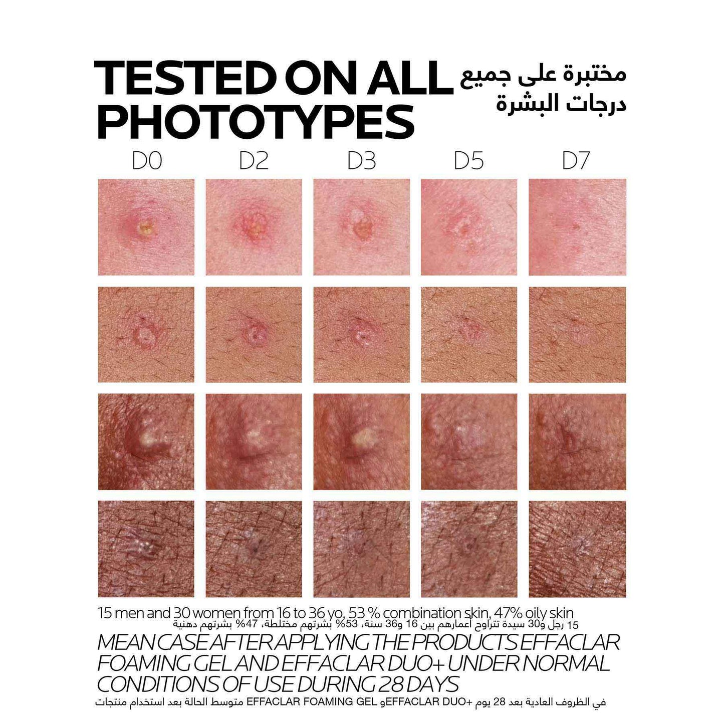 La Roche-posay Effaclar Duo+m 40ml Anti-imperfections Triple Corrective Care for Oily and Acne-prone Skin, Powered by Microbiome Science.